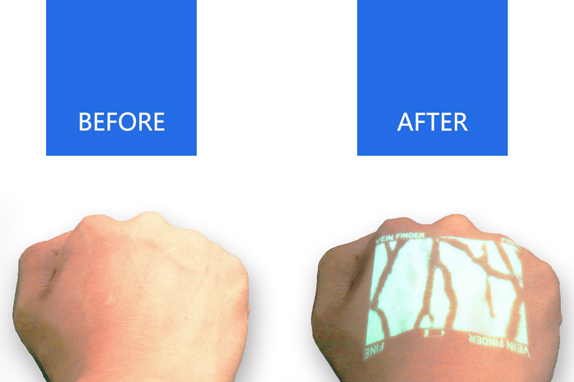 VeinSight/vein finder/vein ligth/vein inlluminator/comparison